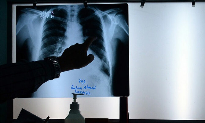 'Genes point to who develops lung disease' 'Genes point to who develops lung disease'