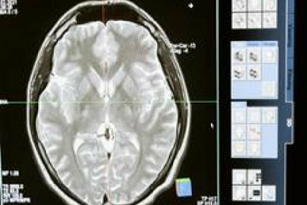 Do you know particular brain reactions to traumatic stress are associated with PTSD risk?