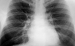 The new regulations are aimed at eradicating instances of black lung