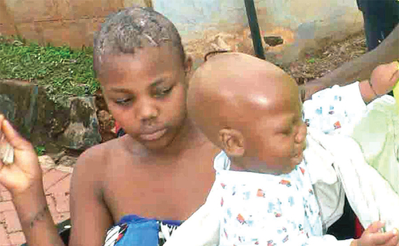 Nakazibwe n’omwana. Omukono ku kkono gwe gwakoseddwa ennyo. Nakazibwe n’omwana. Omukono ku kkono gwe gwakoseddwa ennyo.