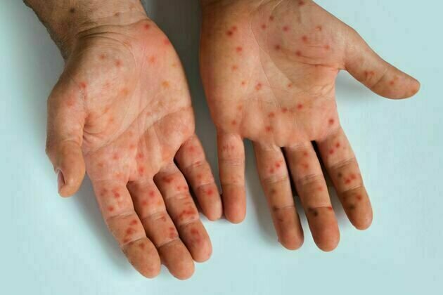 Measles outbreaks end in Michigan, Pennsylvania