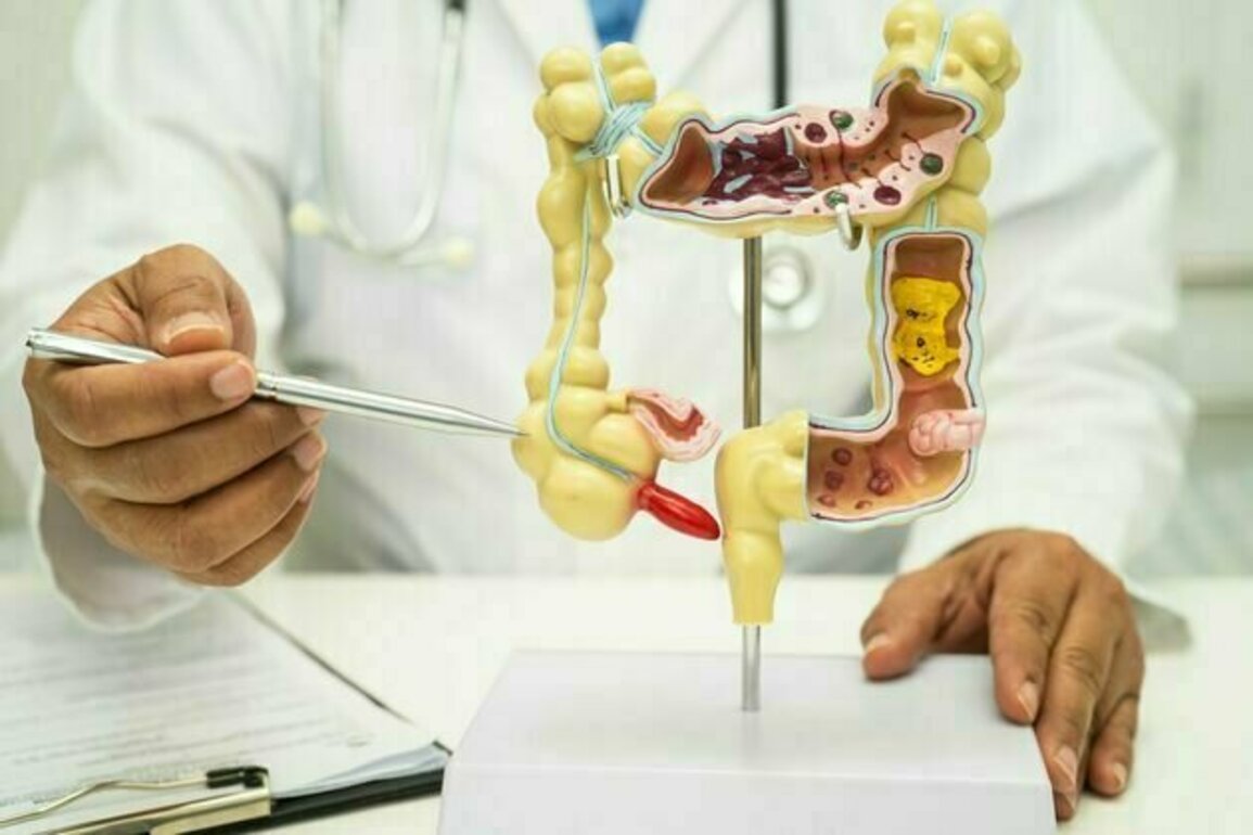 Appendix cancer rising among younger generation - new study