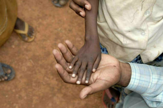 Record levels of child hunger reported in Horn of Africa