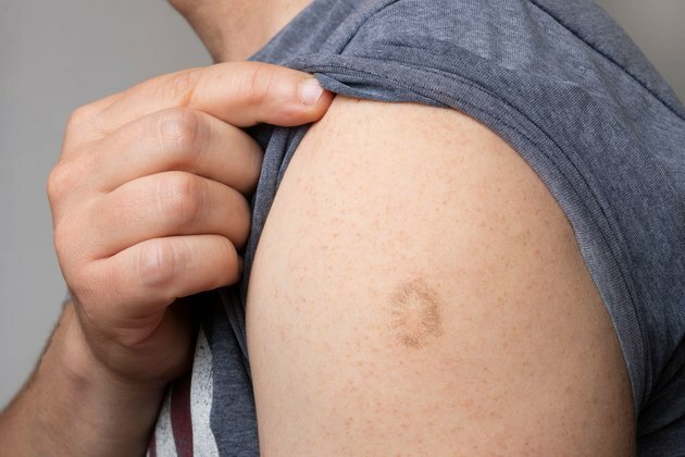 Monkeypox: we have vaccines and drugs to treat it