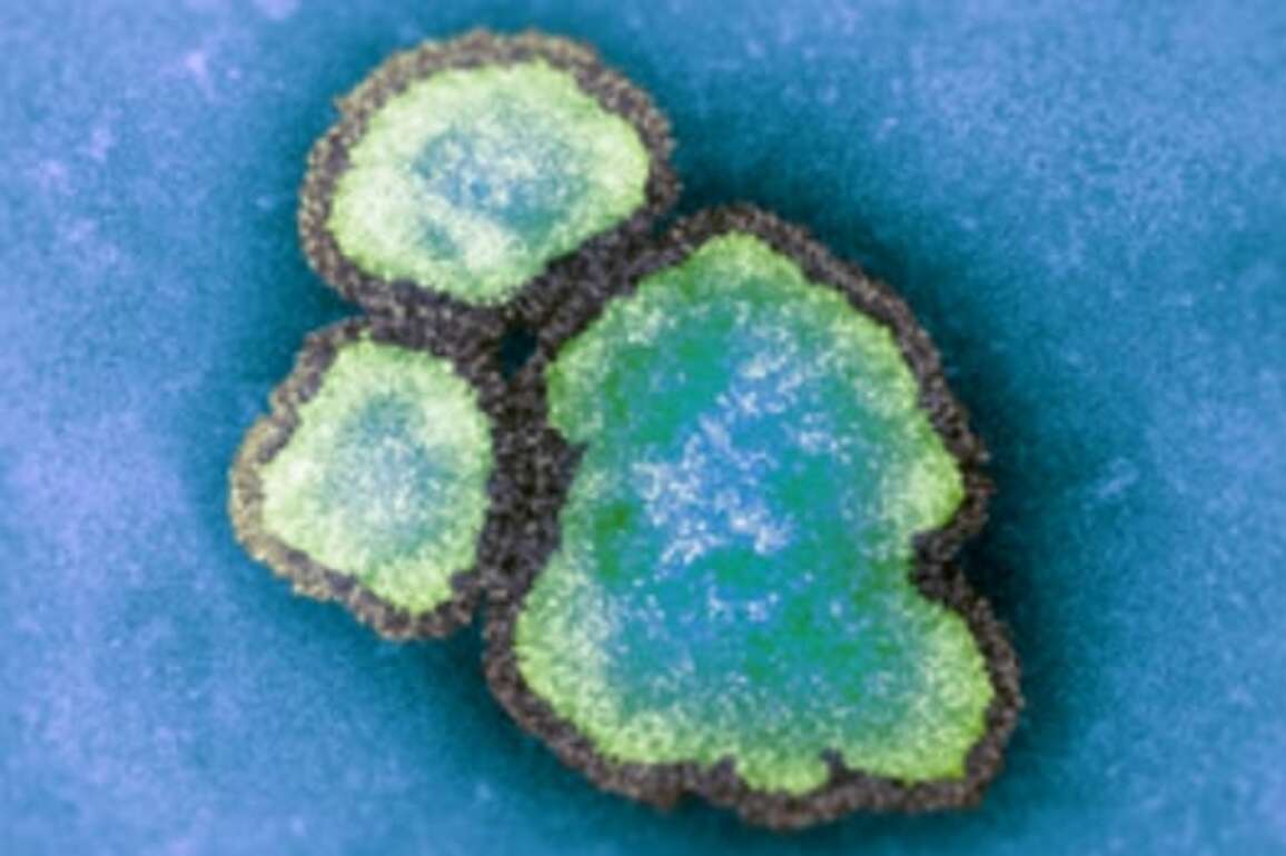 Alberta's measles case counts have topped 500 and doctors are worried