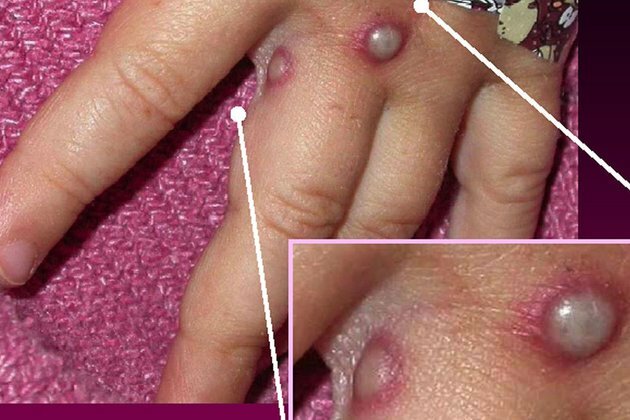 Monkeypox cases just tip of iceberg WHO
