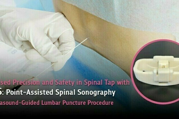 Increased Precision and Safety in Spinal Tap with PASS - An Ultrasound-Guided Lumbar Puncture Procedure