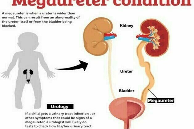 10-year-old Boy from Myanmar with a Congenital Urinary Tract Defect, Cured by Kauvery Hospital