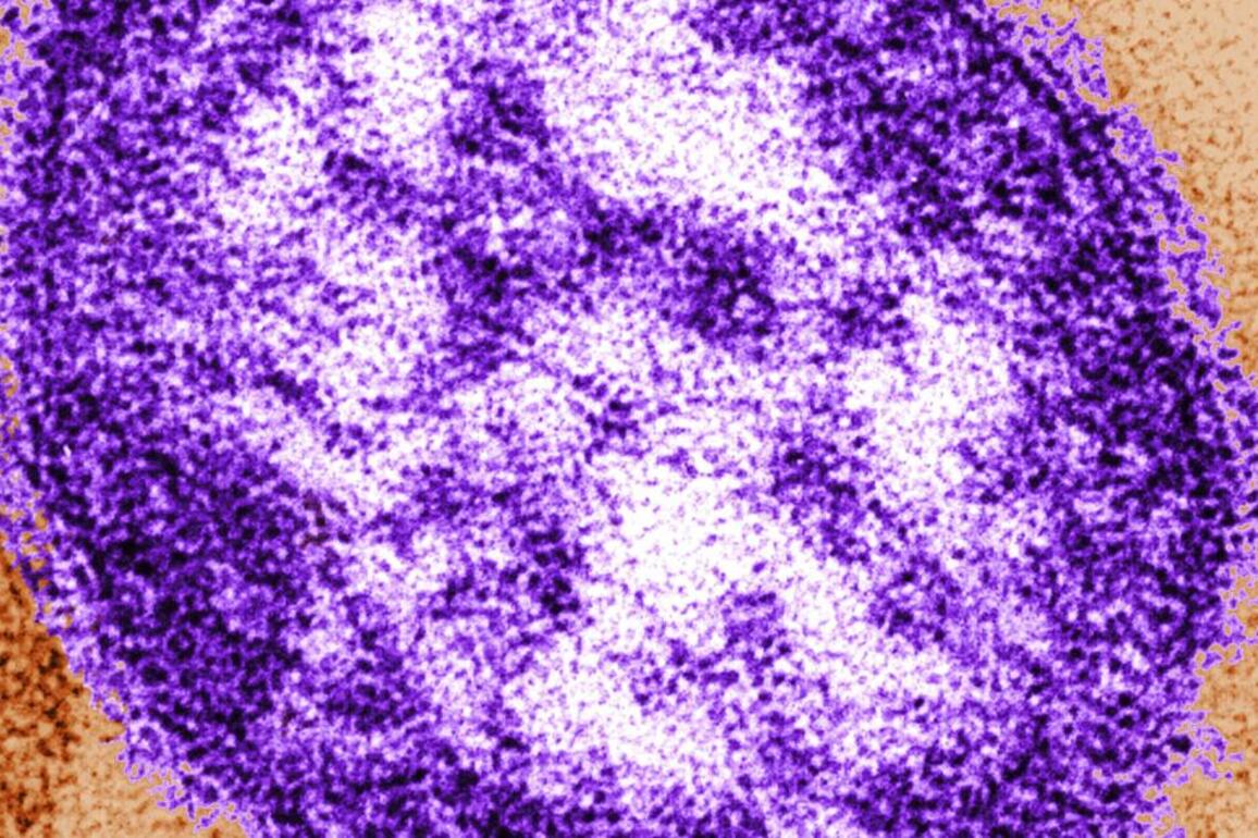 Another measles case reported in L.A. County; vaccination urged