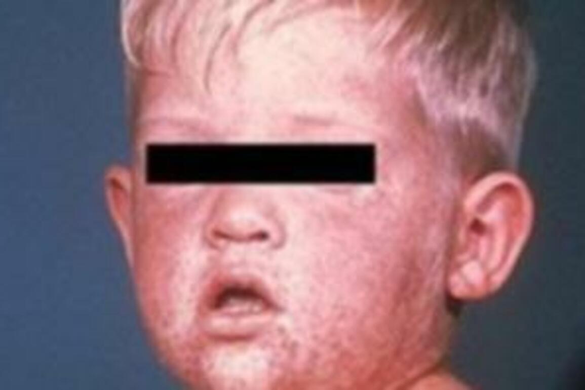 Victoria records worst measles outbreak in a decade
