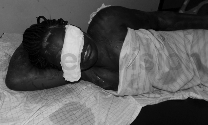 Woman burnt with acid in critical condition Woman burnt with acid in critical condition