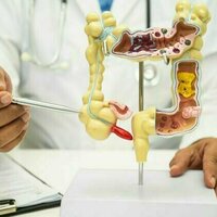 Appendix cancer rising among younger generation - new study