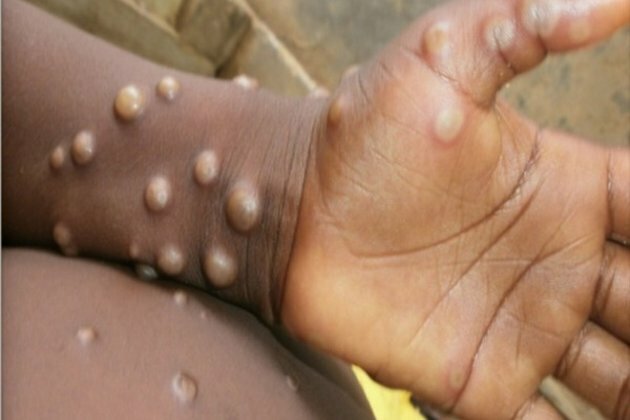 Delhi reports 4th Monkeypox case, India tally goes up to 9