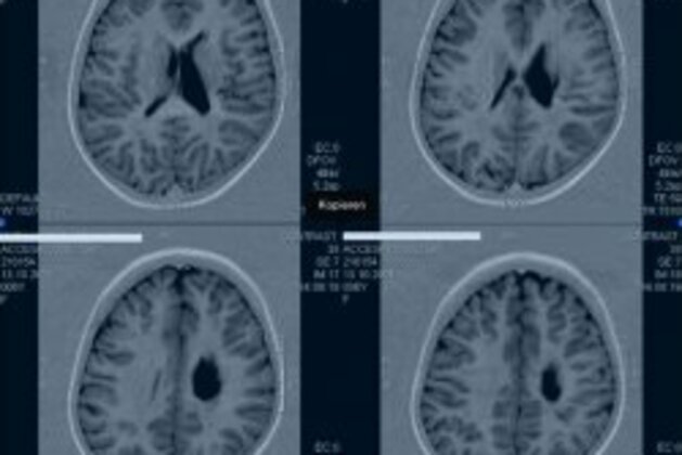 First successful treatment of traumatic paediatric stroke with autologous cord blood 