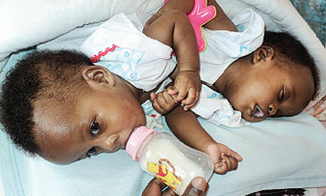 Separated Kabale Siamese twins doing fine Separated Kabale Siamese twins doing fine