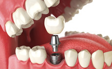 Adiuva Capital-backed AC Dental buys NT Dental 