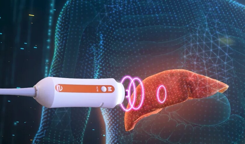 FibroScan in action © echosens