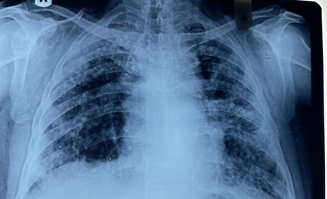 Chest X-ray of a patient diagnosed with silicosis