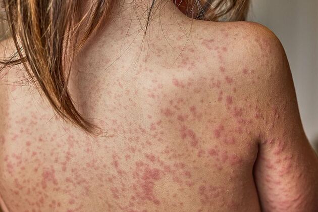 Urgent health warning issued for Sydney after person with measles returns from Vietnam