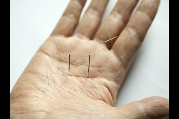 Study reveals acupuncture can reduce migraine headaches
