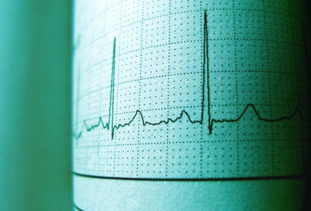 Study uses AI to identify people with irregular heartbeats