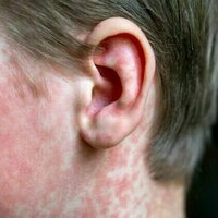 Child dies from complications of measles years after infection - SSPE explained