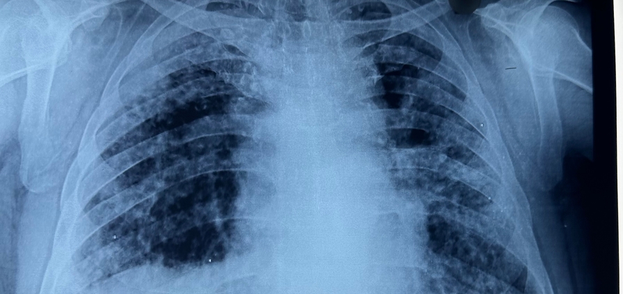 Chest X-ray of a patient diagnosed with silicosis