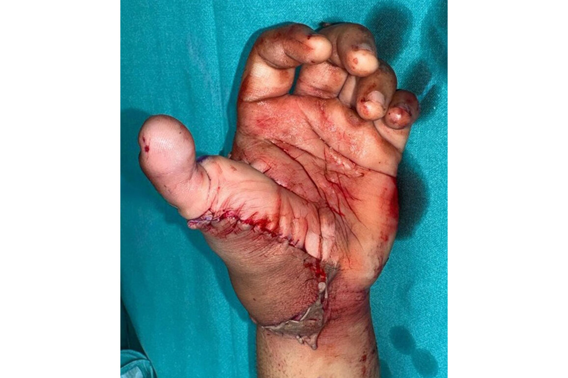 Doctors reconstruct thumb from 20-year-old man's amputated leg in Delhi