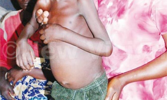 Poor hygiene linked to malnutrition Poor hygiene linked to malnutrition