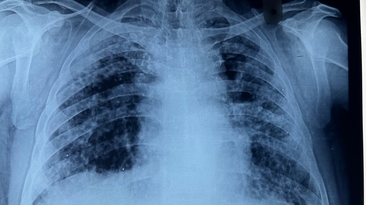 Chest X-ray of a patient diagnosed with silicosis
