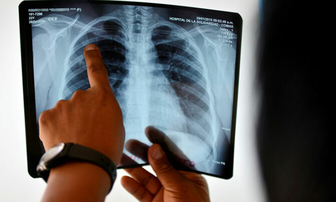 New drug slashes death rates among drug-resistant TB patients New drug slashes death rates among drug-resistant TB patients