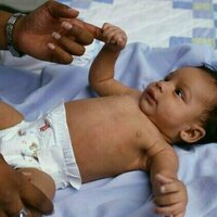 Whooping cough is making a comeback, but the vaccine provides powerful protection