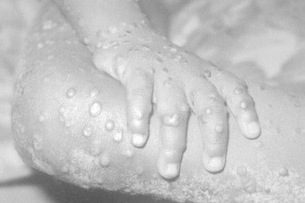 First monkeypox quarantine ordered in EU