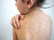 Measles cases in Texas, New Mexico rise to 256