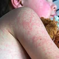 US measles cases surpass 1,000 for first time in 5 years