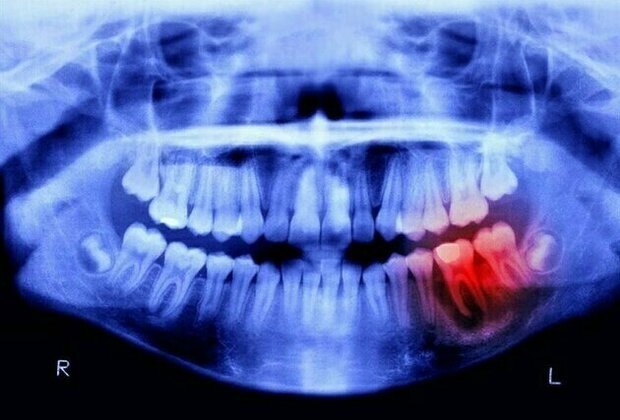 Scientists Begin Human Trials for Tooth-Regrowing Drug