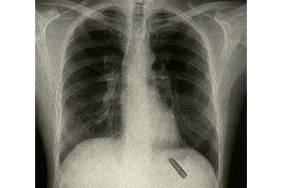 Delhi: Plastic pen cap lodged in patient's lungs removed after 26 years
