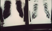 Black lung X-rays. Photo: U.S. National Archives and Records Administration