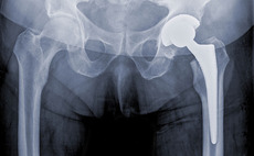 Permira-backed Corin acquires Global Orthopaedic Technology