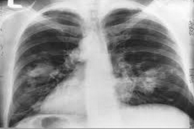 Faridabad hospital introduces cryo technique for lung cancer treatment