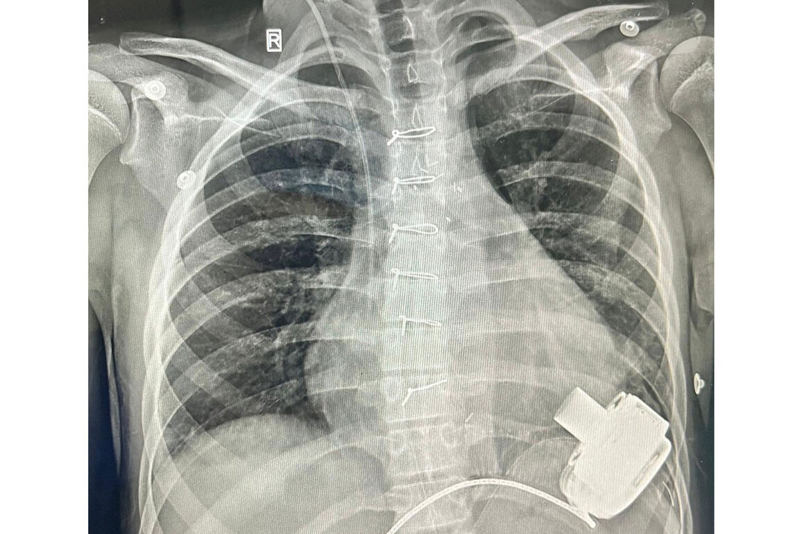Uzbeki child with end-stage heart failure recovers after receiving mechanical heart (LVAD)