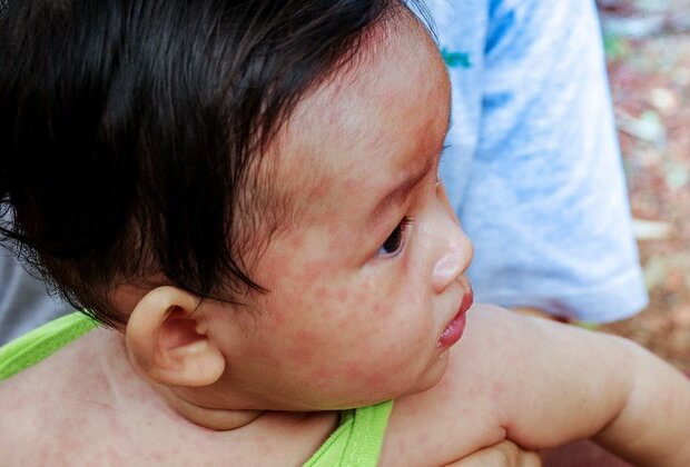 Why parents should fear measles, not the vaccine