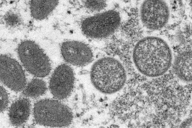 Contacts of 1st monkeypox case asymptomatic 'til end of isolation