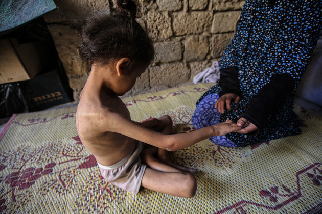 MIDEAST-GAZA CITY-CHILD-MALNUTRITION