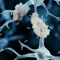 Early-onset Alzheimer's: new drug shows promise in slowing the disease