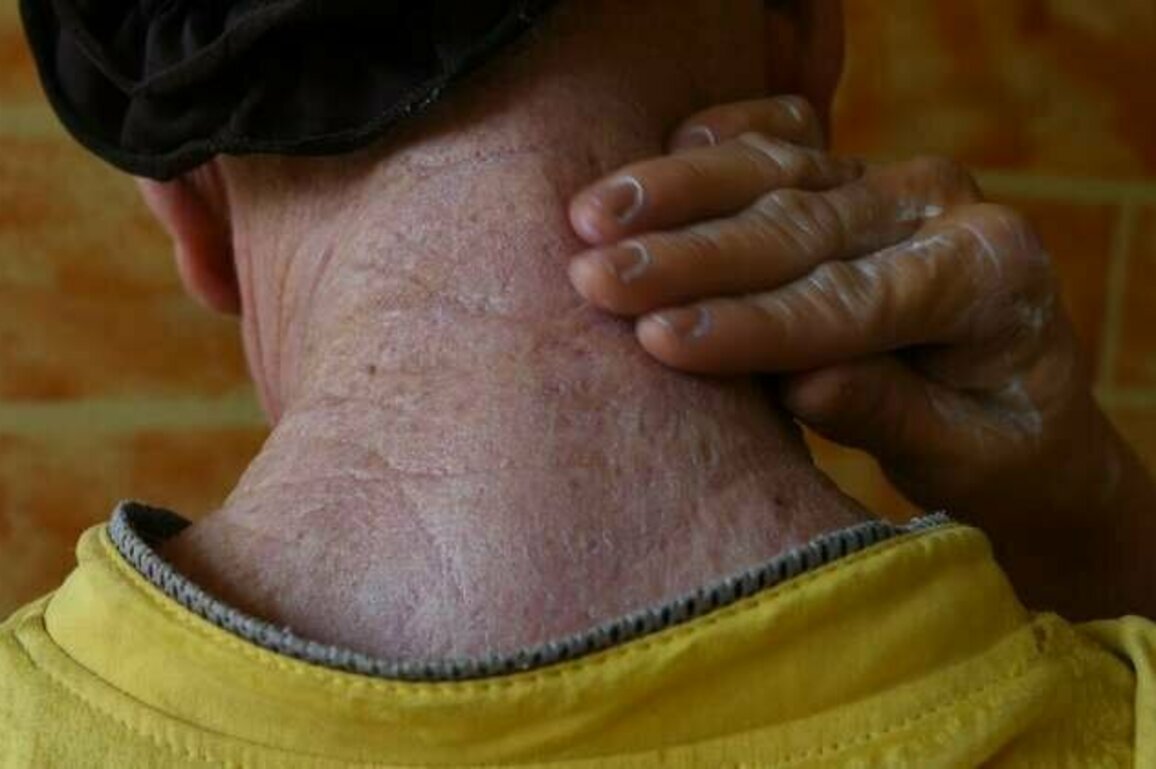 Ensuring Essential Sun Protection for Persons with Albinism
