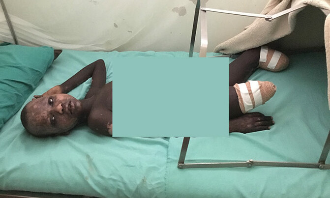 13-year old bomb explosion survivor seeks assistance 13-year old bomb explosion survivor seeks assistance