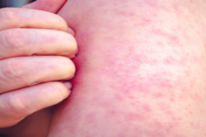 Unvaccinated New Mexico adult tests positive for measles after death