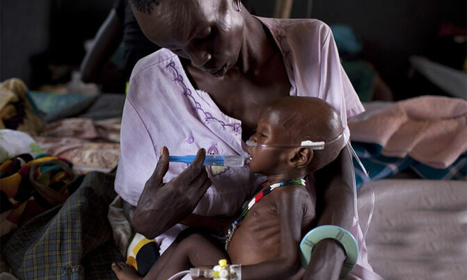 A million children severely malnourished in eastern, southern Africa: UN A million children severely malnourished in eastern, southern Africa: UN