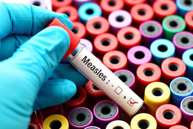 South Africa records over 3,400 measles cases